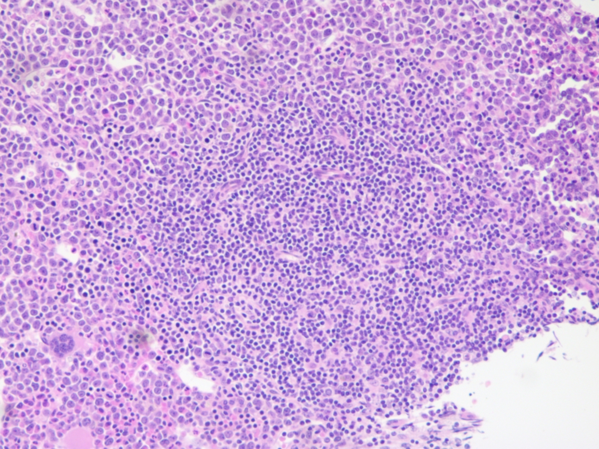 Bone marrow biopsy, lymphoid collection